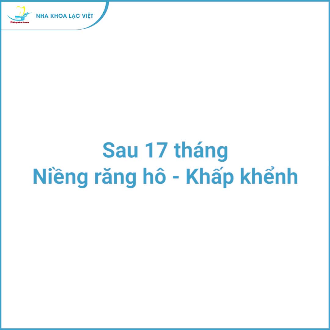 TỰ TIN CƯỜI HẾT CỠ SAU 17 THÁNG NIỀNG RĂNG