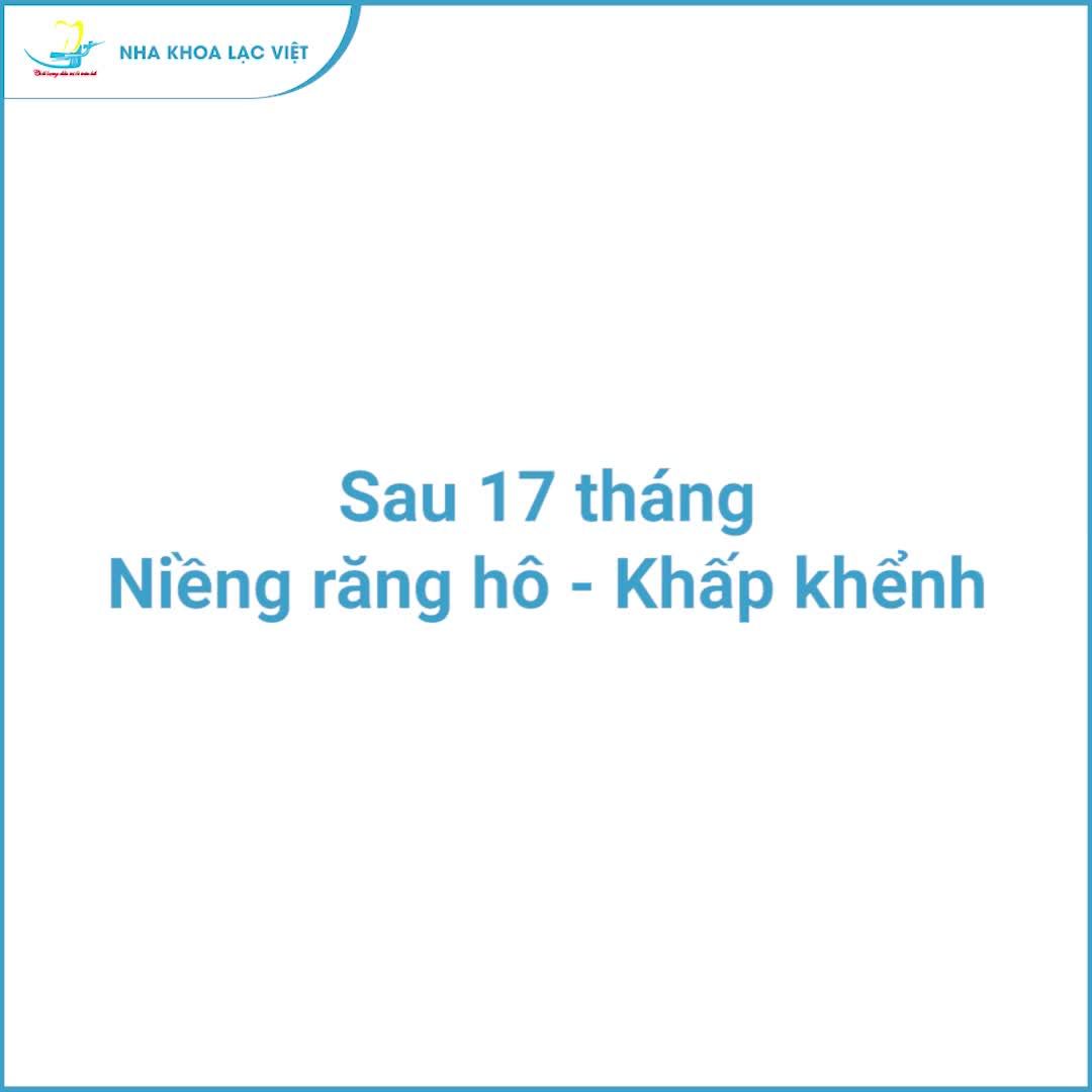 TỰ TIN CƯỜI HẾT CỠ SAU 17 THÁNG NIỀNG RĂNG