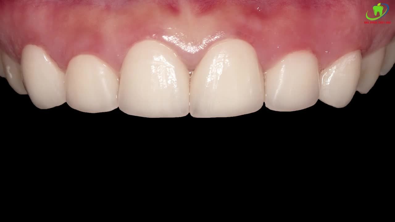 SMILE DESIGN LÀ GÌ