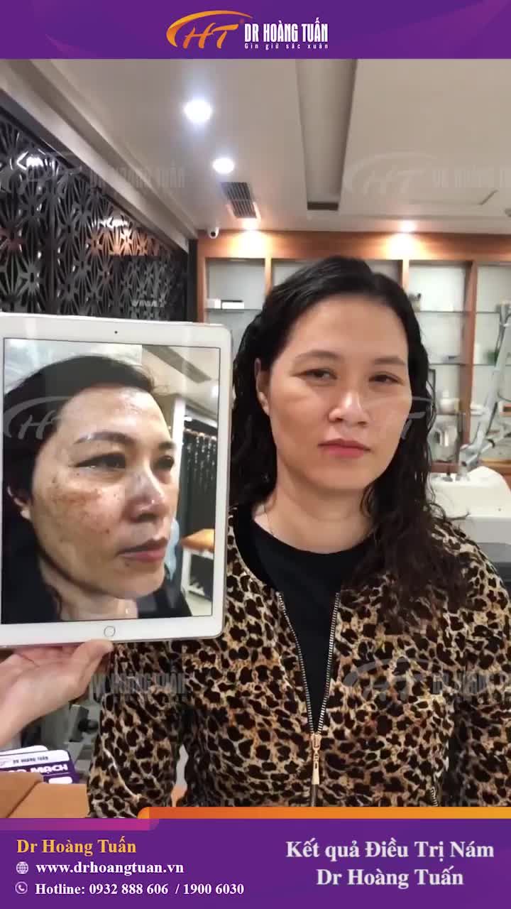 Ngắm nhìn cận cảnh kết quả sau liệu trình trị nám tại Dr Hoàng Tuấn