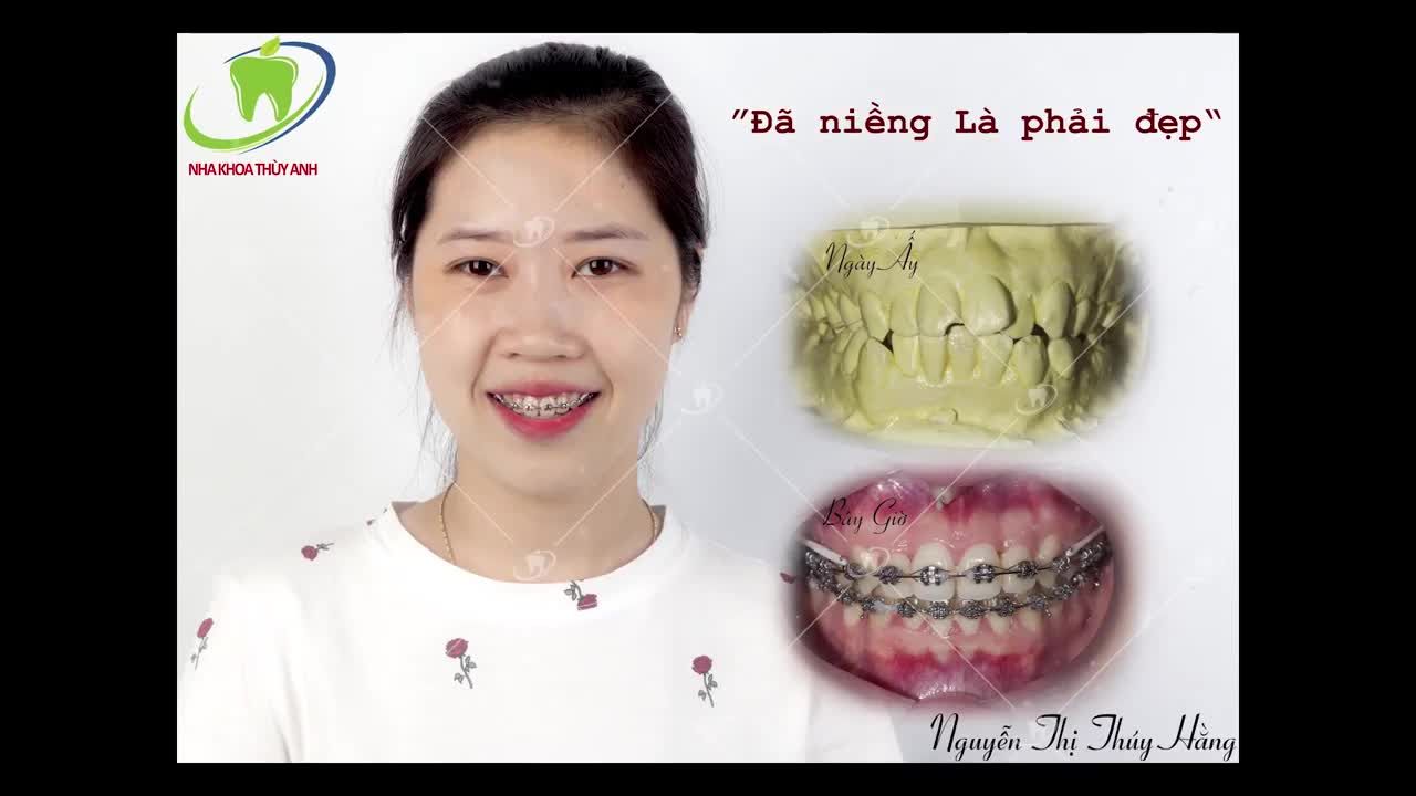 SỞ HỮU NỤ CƯỜI NHƯ MONG MUÔN SAU KHI NIỀNG RĂNG