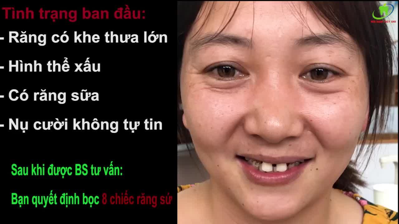 ĐÁNH BAY MỌI NỖI SỢ KHI BỌC RĂNG SỨ TẠI NHA KHOA THÙY ANH