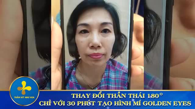 Kết quả cắt mí Golden Eyes - Cải thiện mí sụp, da chùng, mỡ thừa - Trẻ hóa đôi mắt với nếp mí to tròn, cân đối cho nữ khách hàng 47 tuổi.
