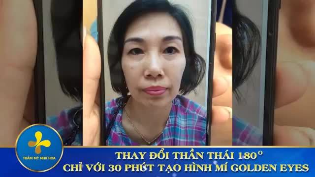 Kết quả cắt mí Golden Eyes - Cải thiện mí sụp, da chùng, mỡ thừa - Trẻ hóa đôi mắt với nếp mí to tròn, cân đối cho nữ khách hàng 47 tuổi.