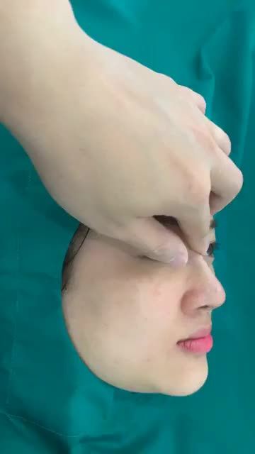 Quá trình nâng mũi - Biến mũi thấp tẹt thành cao tây