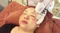 Cấy tinh chất điều trị nám - Lý do của sự biến mất của hơn 90% nám sạm trên da.