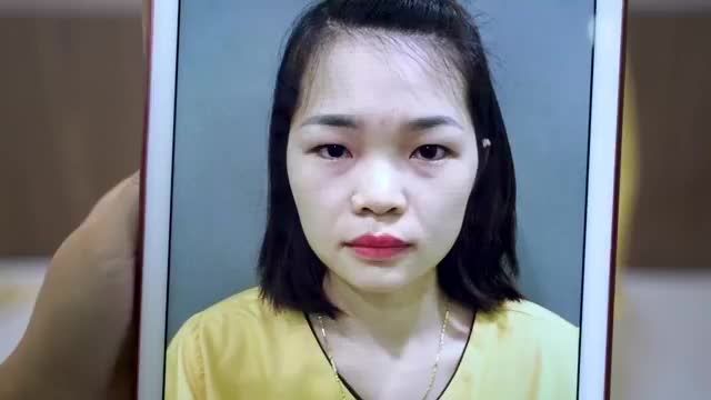 30 phút Cắt mí tại VTM DR HẢILÊ