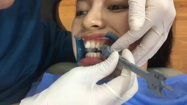 Gắn mắc cài chỉnh nha cho chị Thu Hương.