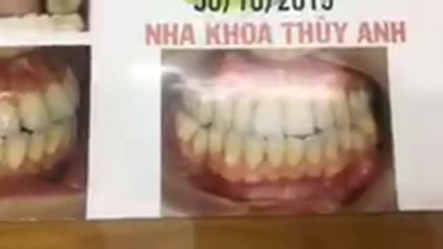 Gắn mắc cài tại Nha Khoa Thuỳ Anh.