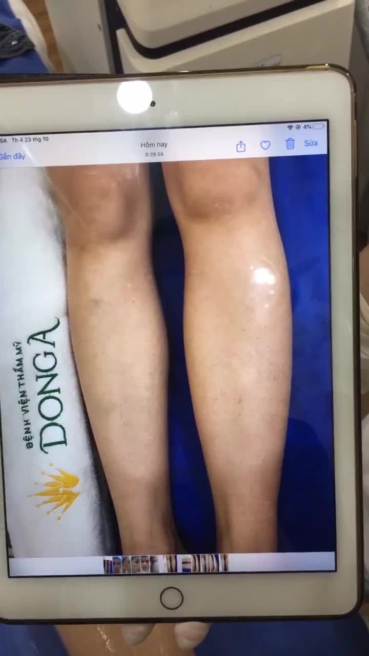 Đánh bay Vi-ô-lông nhờ công nghệ triệt lông Diode Laser