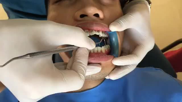 Gắn mắc cài cho bạn Thắng tại Nha Khoa Thuỳ Anh.