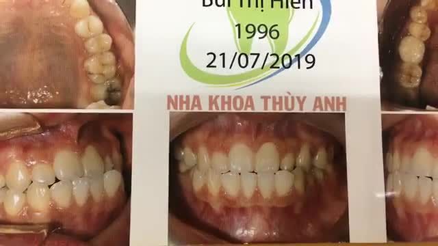 Gắn mắc cài cho bạn Hiền tại Nha Khoa Thuỳ Anh.