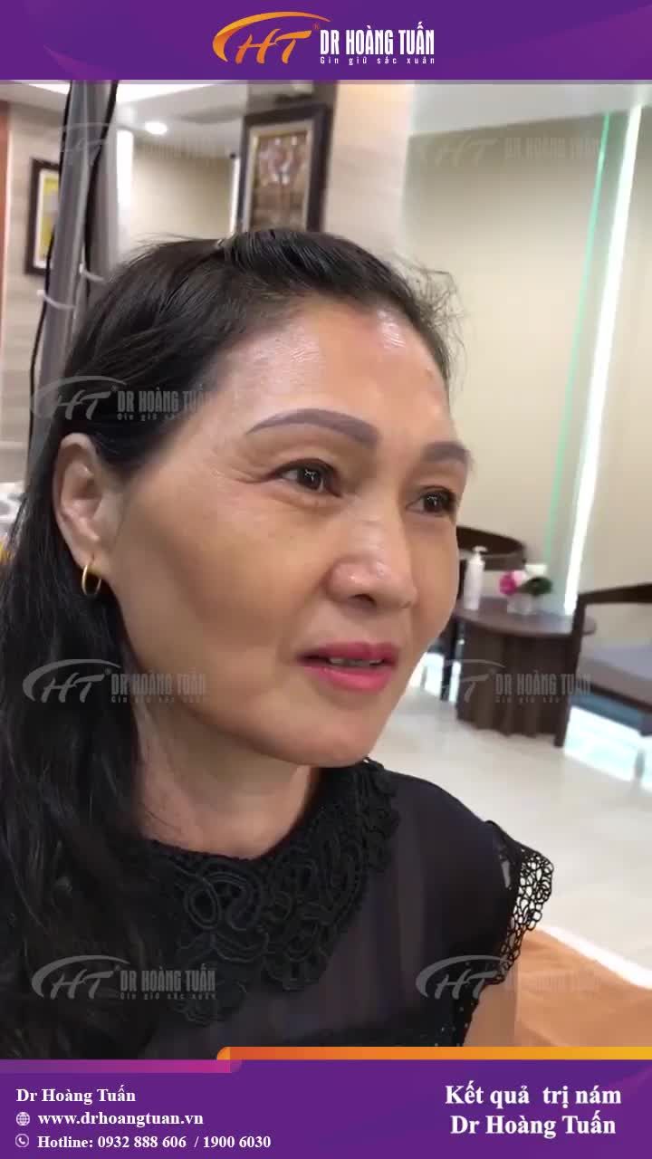 Cô Lan đã điều trị thành công nám khó ở độ tuổi U50 tại Dr Hoàng Tuấn