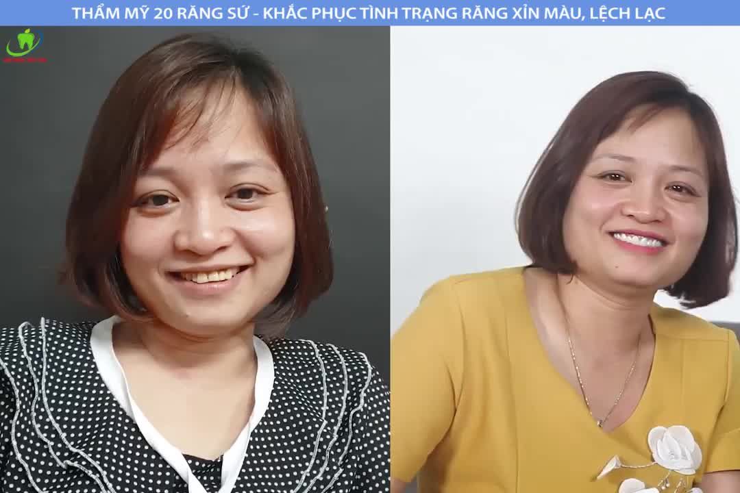 Kết quả sau khi khắc phục răng bị nứt dọc thân răng, xỉn màu, răng hô mất thẩm mỹ.