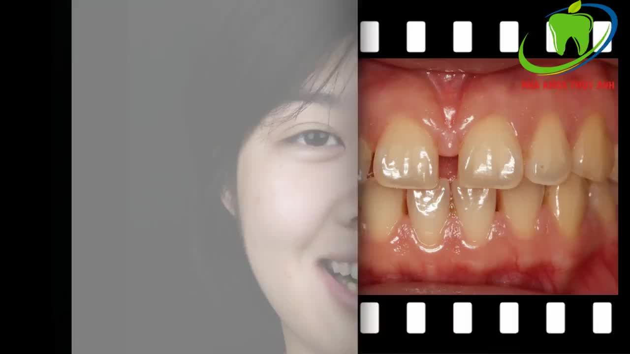 BỌC RĂNG SỨ - HOÀN THIỆN NỤ CƯỜI MỘT CÁCH CHÂN THỰC NHẤT