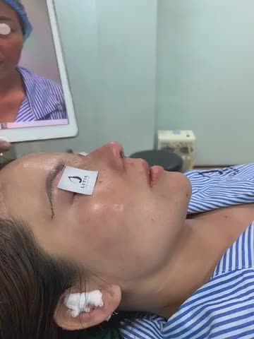 COMBO: NÂNG CUNG MÀY + SỬA LẠI MŨI CẤU TRÚC, LẤY CHỈ, CHỈNH XƯƠNG, GIA CỐ SỤN VÁCH NGĂN