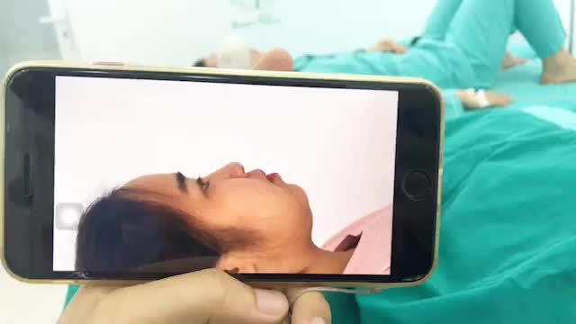 NÂNG MŨI PHƯƠNG PHÁP SIÊU CẤU TRÚC