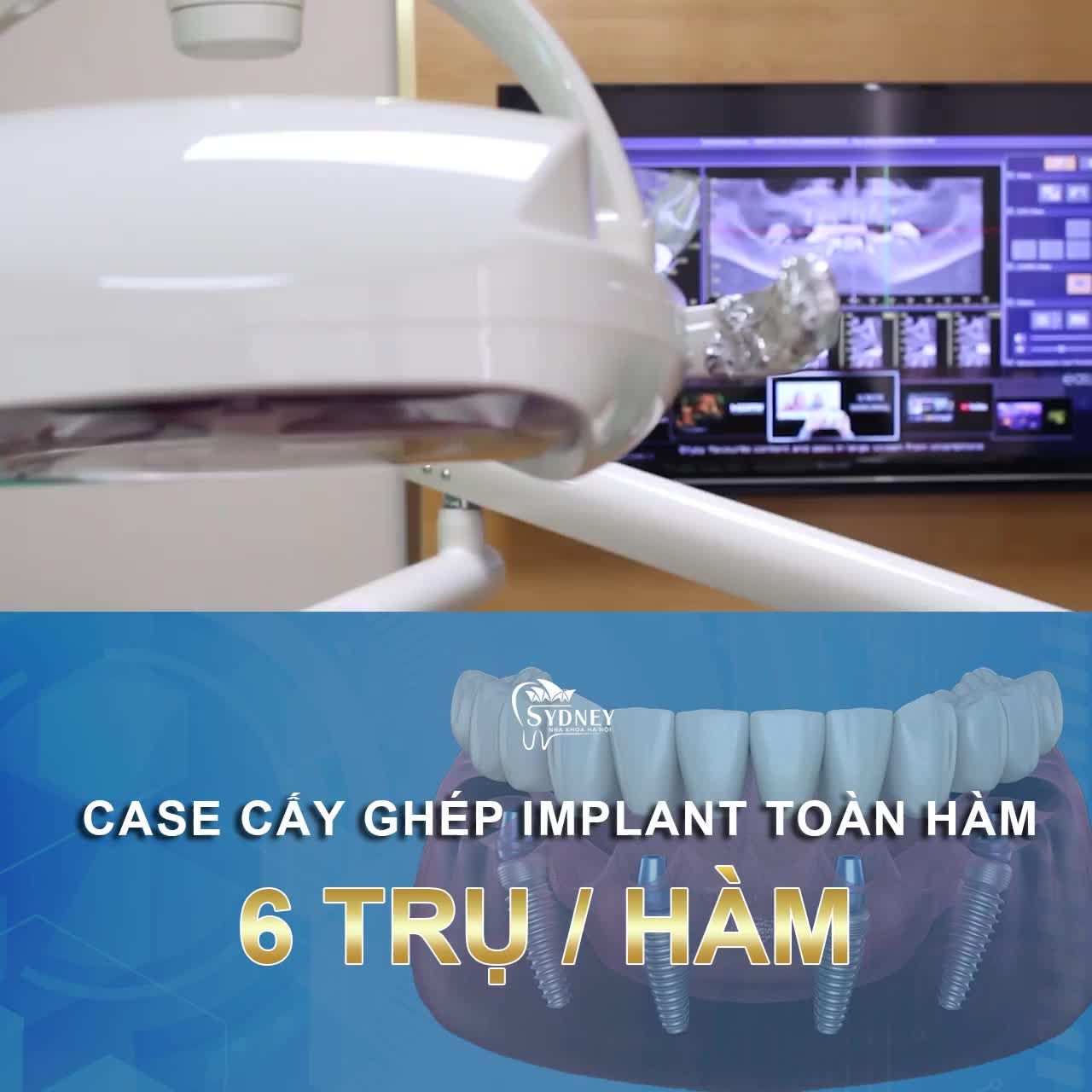 PHỤC HÌNH RĂNG MẤT TOÀN HÀM BẰNG PHƯƠNG PHÁP CẤY GHÉP IMPLANT ALL - ON 6
