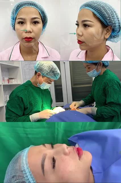 TẠO SAO LẠI NÂNG MŨI CẤU TRÚC