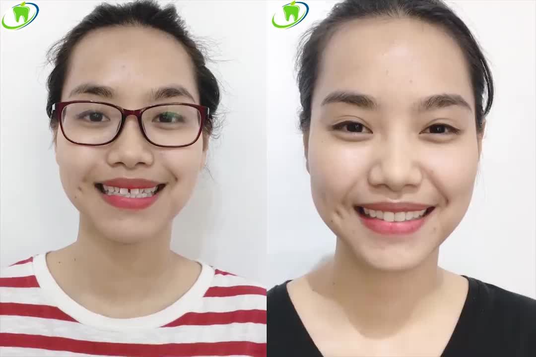 Răng thưa, răng dị dạng sửa thế nào cho đẹp