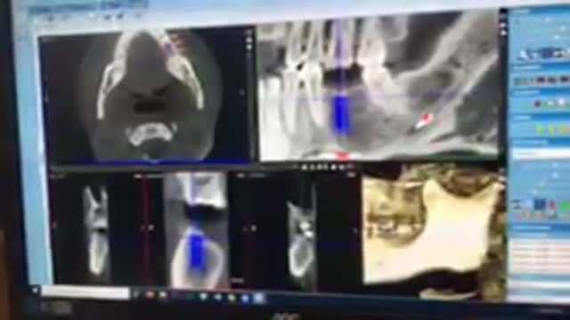 Cắm chân răng nhân tạo Implant cho anh Hà tại Nha Khoa Thuỳ Anh.