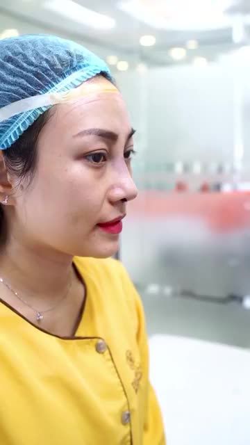 Xem tận mắt kết quả nâng mũi Medi Form tại Dr. Hải Lê - Sự thay đổi nhan sắc tuyệt vời
