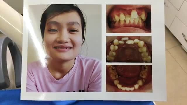 Tháo mắc cài cho khách hàng tại Nha Khoa Thùy Anh