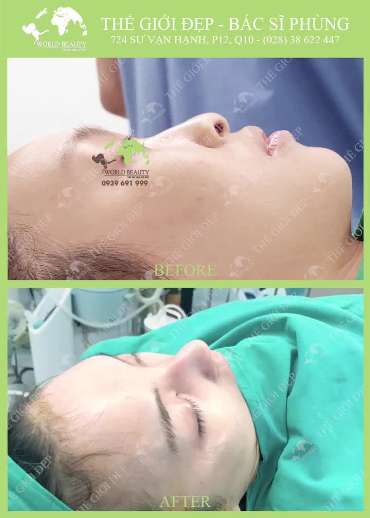 5 Lý do vì sao bạn nên chọn nâng mũi bằng sụn tự thân cho lần đầu tiên