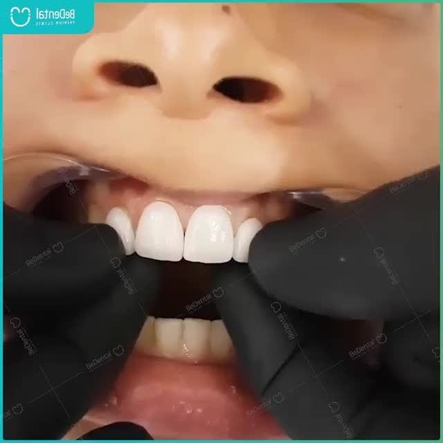 CẬN CẢN QUY TRÌNH THỬ RĂNG SỨ VENEER TRƯỚC KHI GẮN CỐ ĐỊNH