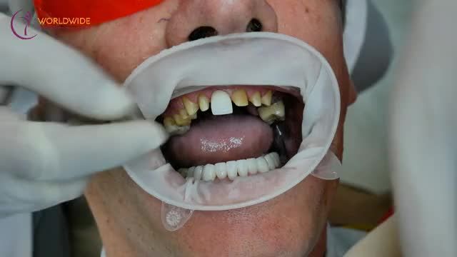 CẬN CẢNH CASE GẮN 20 RĂNG SỨ THẨM MỸ TẠI BỆNH VIỆN WORLDWIDE