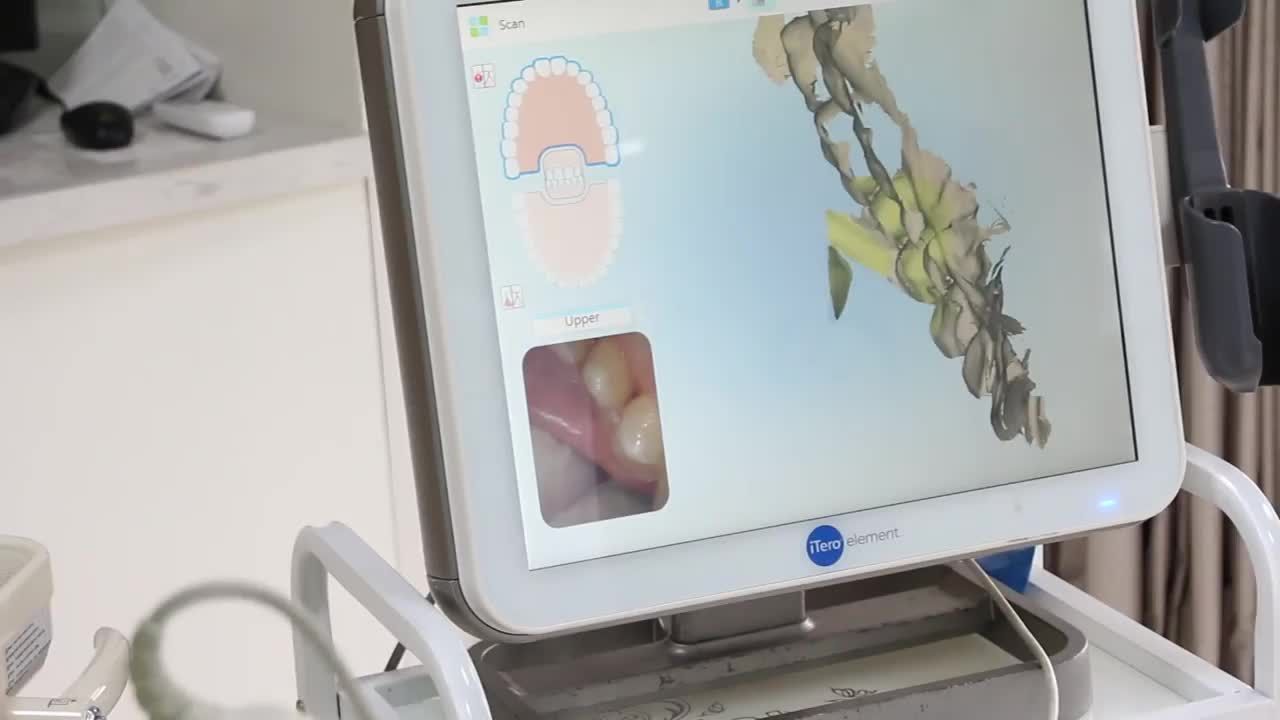 Case lấy dấu 2 hàm 3D bằng máy iTero Element tạo Clincheck trong chỉnh nha Invisalign cho bệnh nhân Đ. H. N - 32 tuổi ở Hà Nội