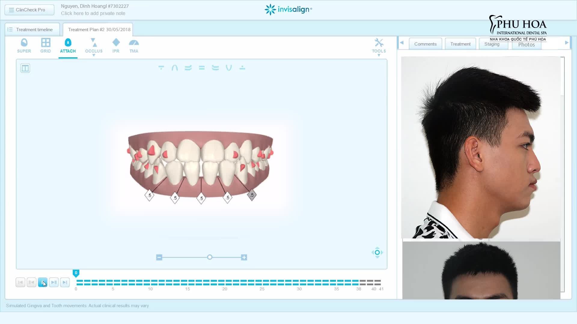Chỉnh nha Invisalign hay còn gọi là niềng răng không mắc cài, là một cuộc cách mạng trong thẩm mỹ nha khoa.