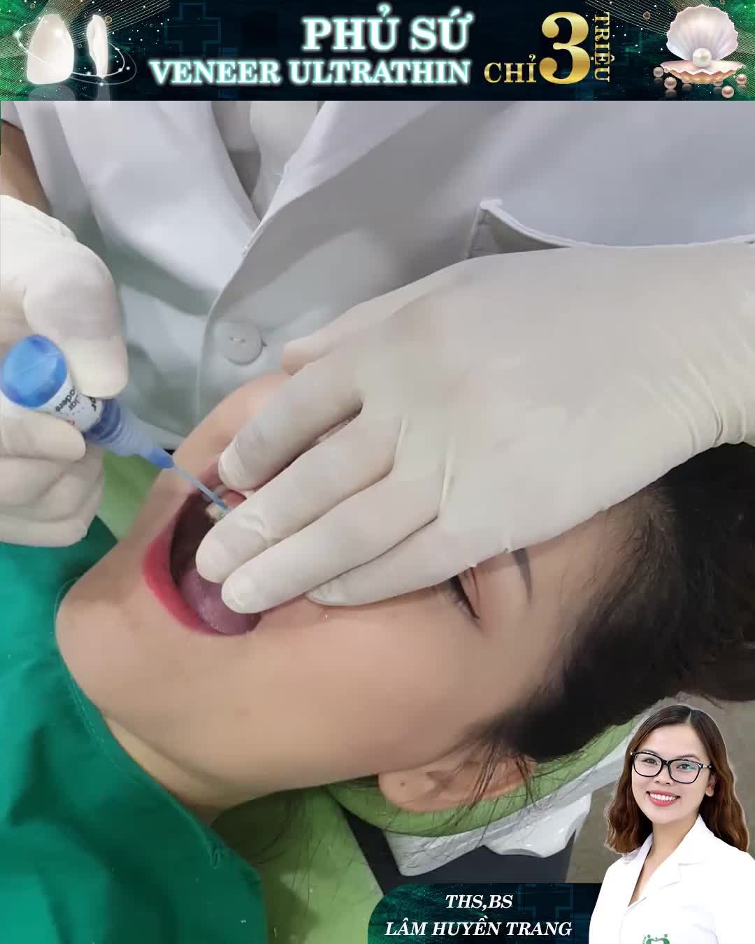 DÁN SỨ VENEER: CƯỜI ĐẸP MÊ LY – KHÔNG LO CHI PHÍ