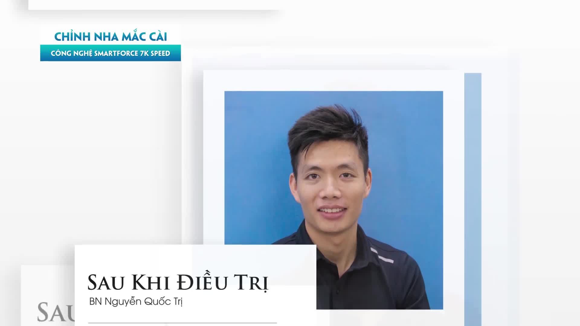 ĐIỀU TRỊ CẮN SÂU, RĂNG HÔ BẰNG NIỀNG RĂNG MẮC CÀI