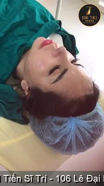 Mời các bạn cùng theo dõi kết quả sau phẫu thuật nâng mũi của hot face Lin Đa nhé!