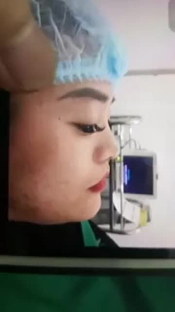 Nâng mũi hỏng lên hỏng xuống mấy lần tại Spa cỏ