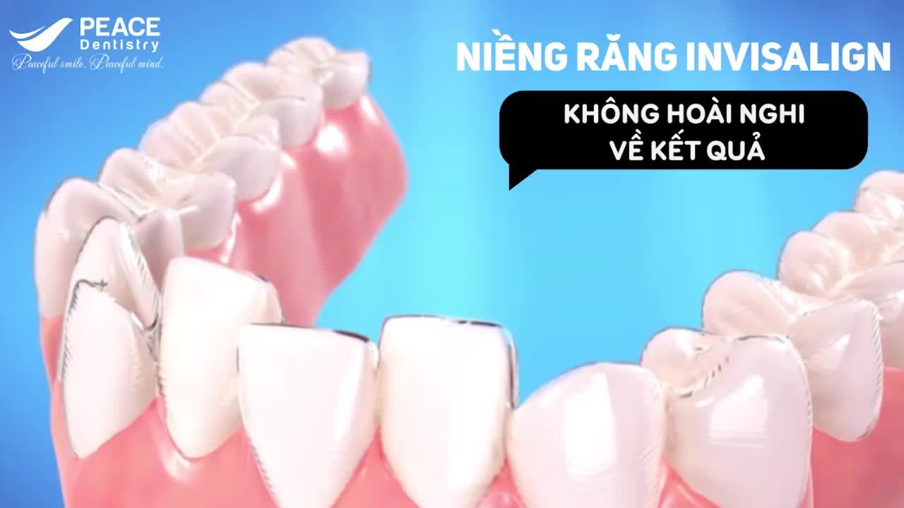 NIỀNG RĂNG INVISALIGN – KHÔNG MẮC CÀI, KHÔNG HOÀI NGHI KẾT QUẢ