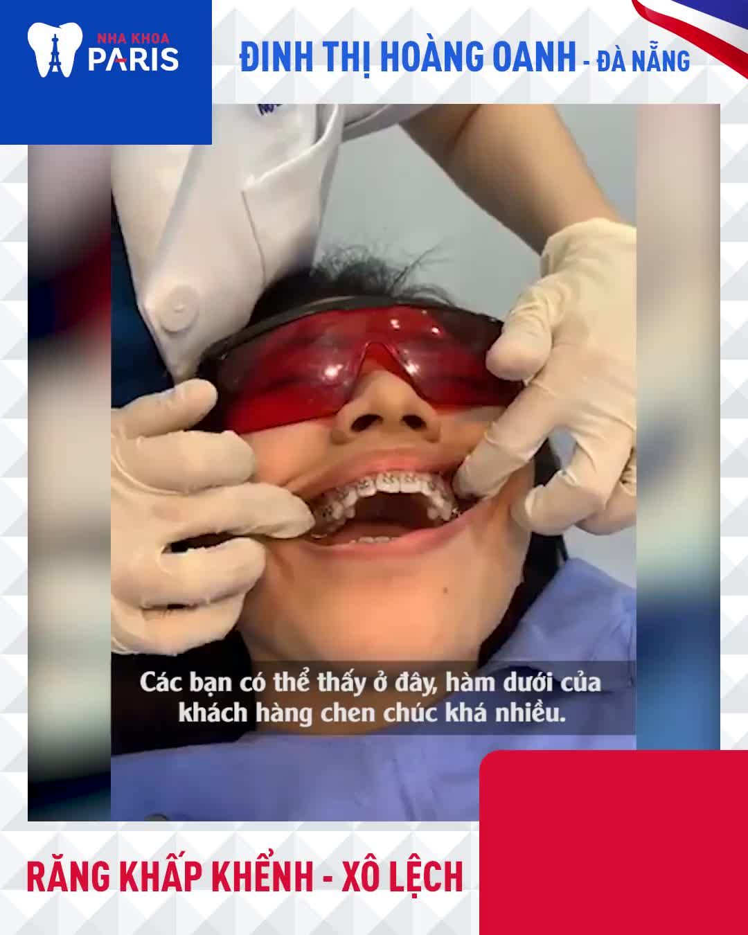 NIỀNG RĂNG KHẤP KHẺNH, XÔ LỆCH THAY ĐỔI DIỆN MẠO