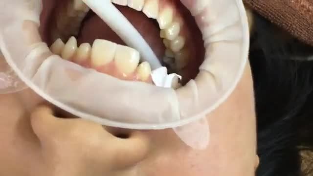 Quá trình dán 4 veneer sứ điều trị răng thưa, hình thể răng mất cân đối tại Nha Khoa Vân Anh - Bắc Ninh