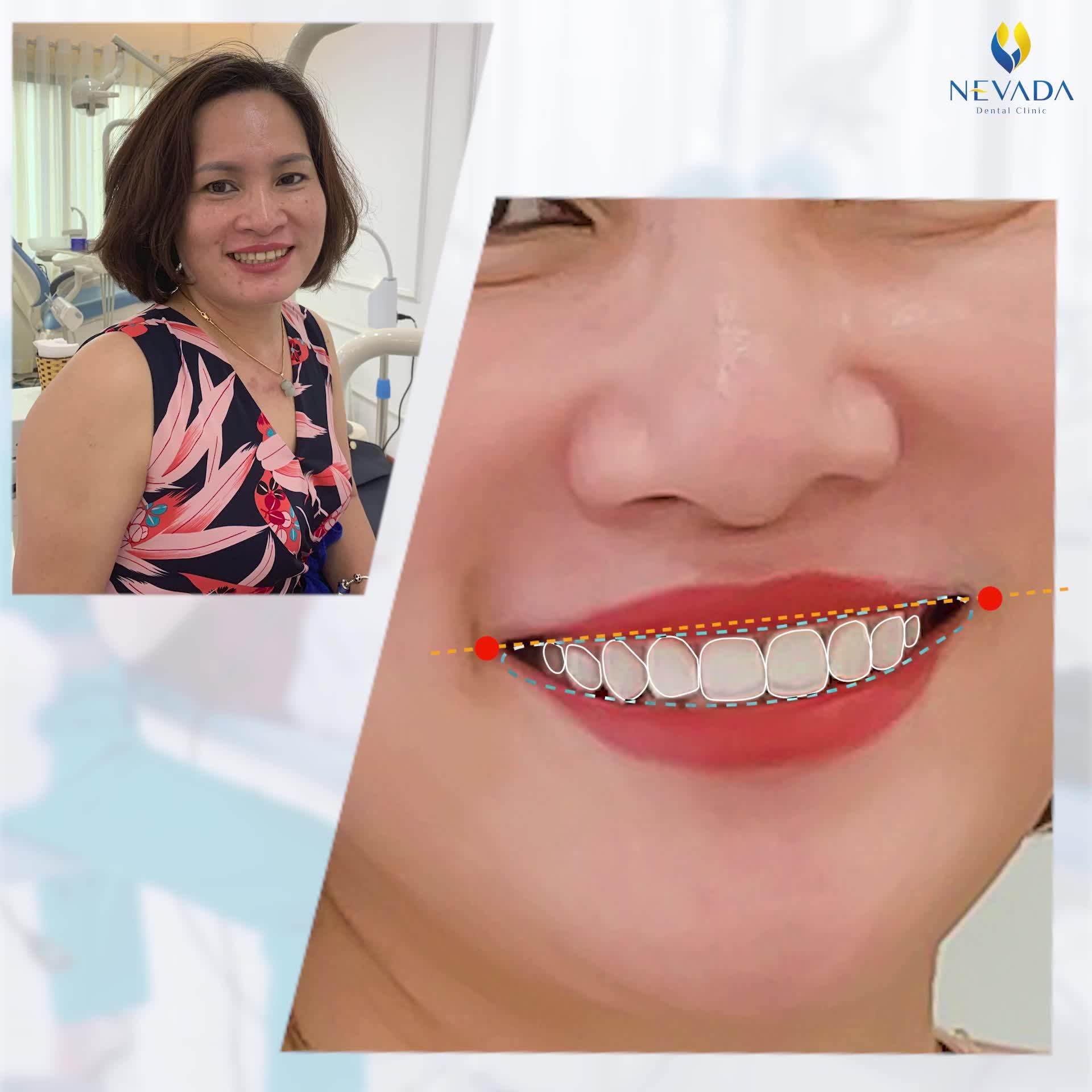 RĂNG ĐỀU HẠT BẮP - ĐẸP XUẤT SẮC CHỈ SAU 3 TIẾNG