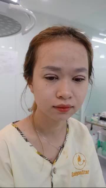 SAU TIỂU PHẪU CA CẮT MÍ MẮT TẠI DR.HOẠT VỪA THỰC HIỆN XONG