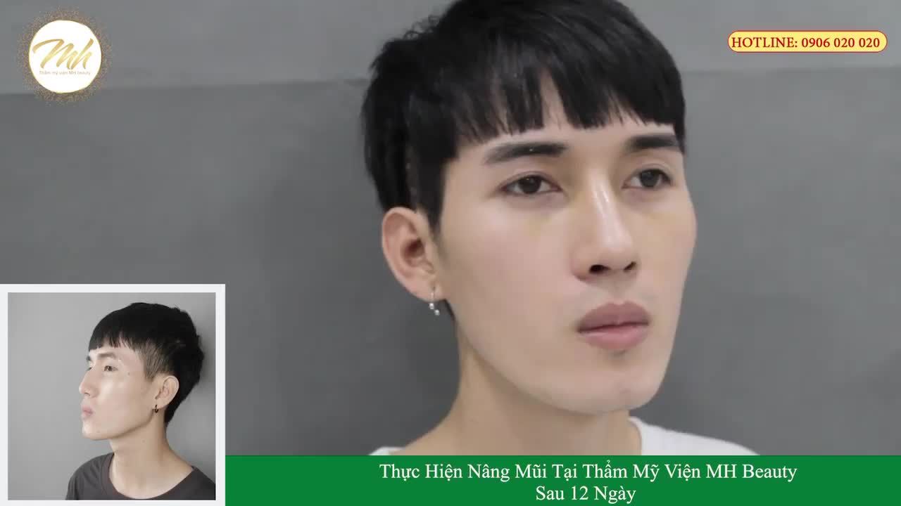 Sự thay đổi ngoạn mục của bạn nam sau khi đến TMV MH Beauty nâng mũi .