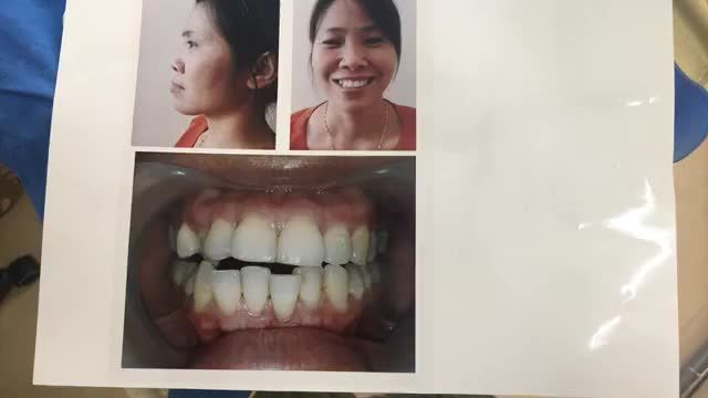 Tháo mắc cài, hoàn thành quá trình niềng răng của chị Thu.