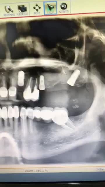 Trồng răng implant