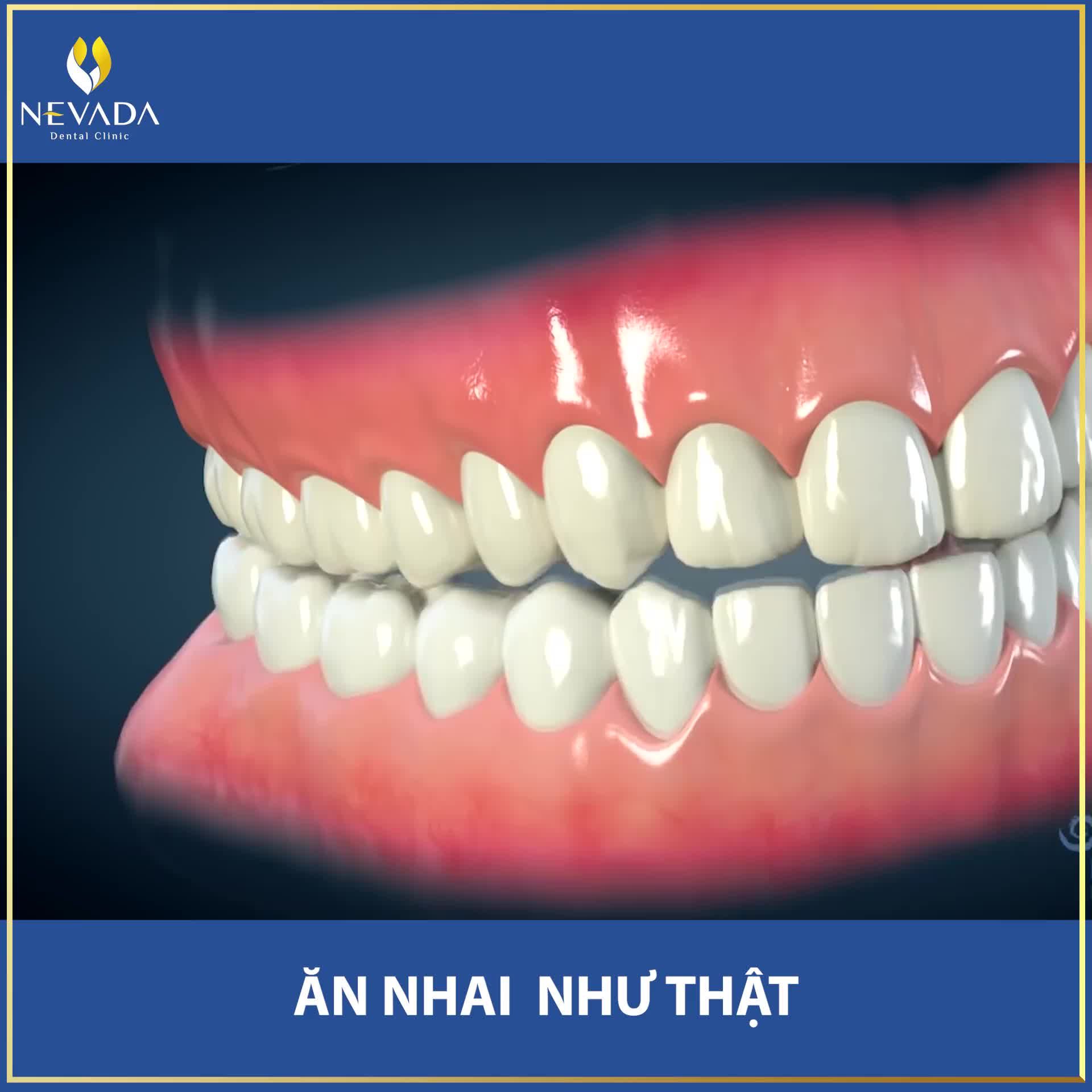 VÌ SAO CẤY GHÉP IMPLANT ĐƯỢC ƯA CHUỘNG ĐẾN VẬY