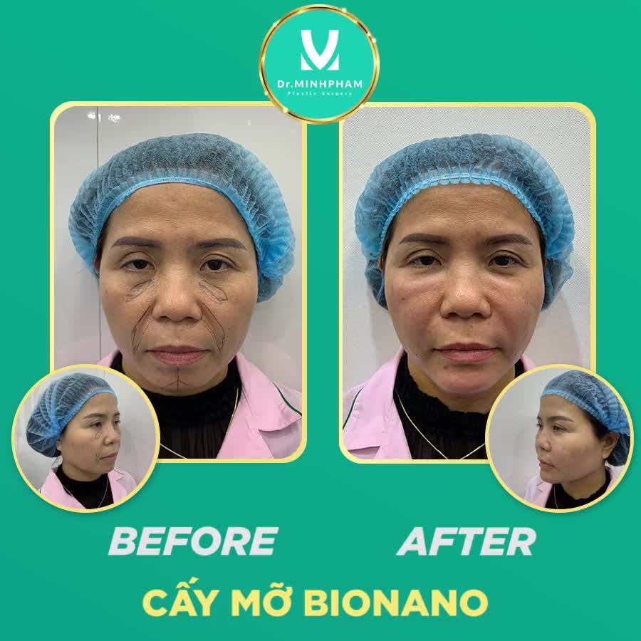 COMBO CẤY MỠ BIONANO - ĐỘN CẰM