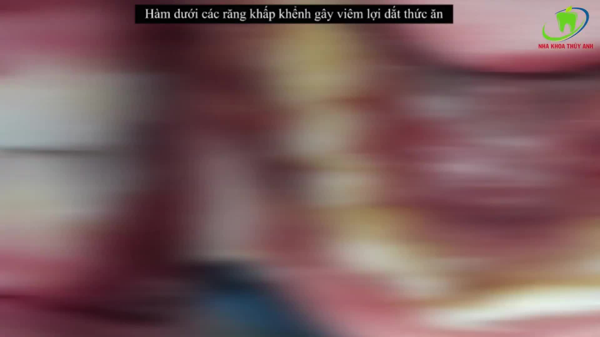 NIỀNG RĂNG CÓ PHÂN BIỆT TUỔI TÁC.