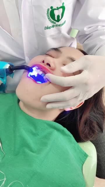 PHỦ MÀNG SỨ VENEER SIÊU MỎNG - Bảo tồn răng gốc - Không mài nhỏ răng tại Nha khoa Gia Đình.