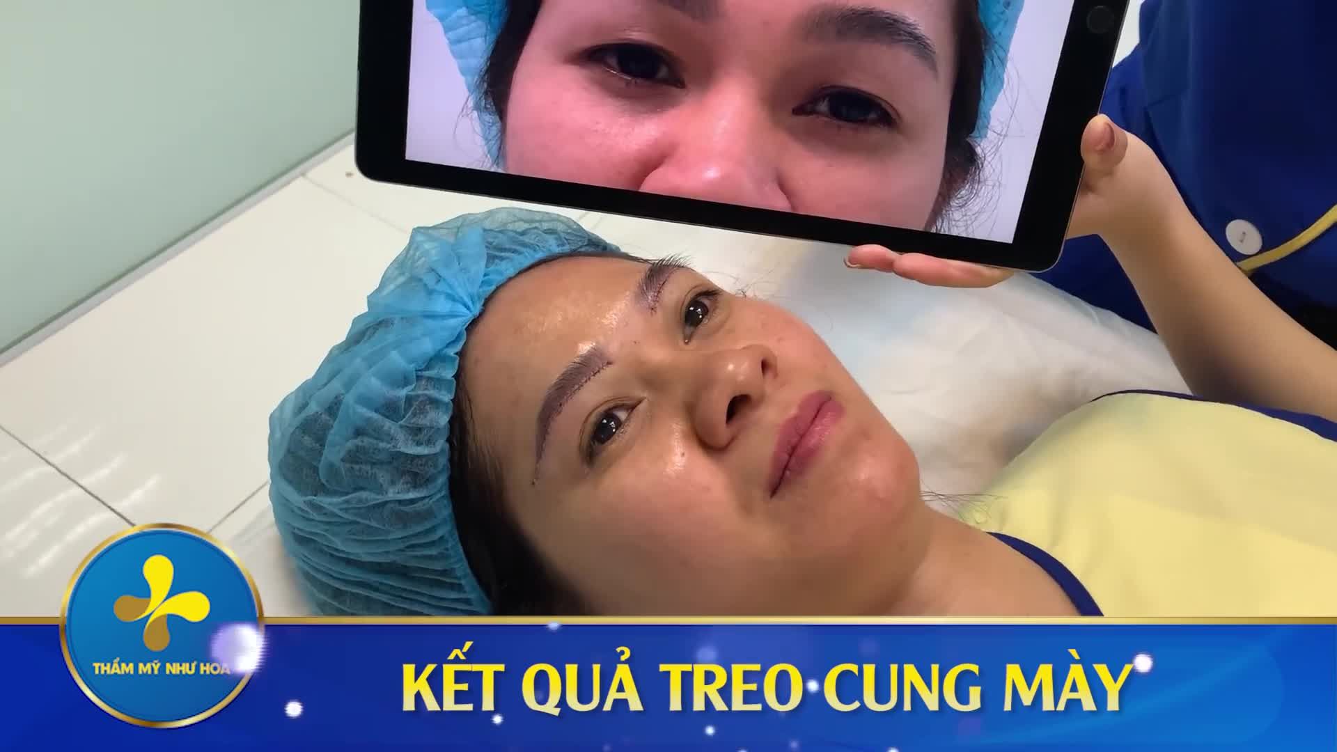 TRẺ LẠI 10 TUỔI NHỜ TREO CUNG MÀY