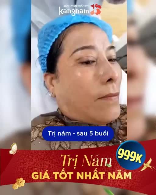 Bất ngờ kết quả sau 5 BUỔI TRỊ NÁM PICOSURE